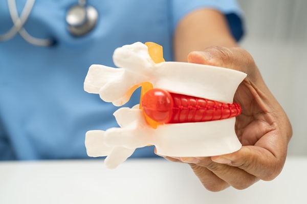 Medical professional holding a spinal model showing a herniated disc pressing against the spinal cord, used to explain back injuries and potential surgical treatment options.