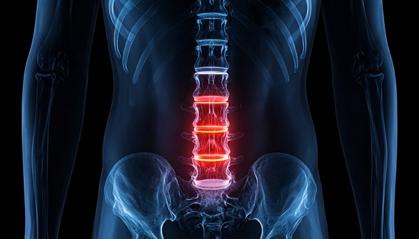 X-ray highlighting the lower spine and lumbar discs in red to indicate injury or spinal fusion area.
